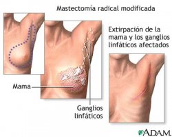 Se realizó en Saladas la primera operación de mamas